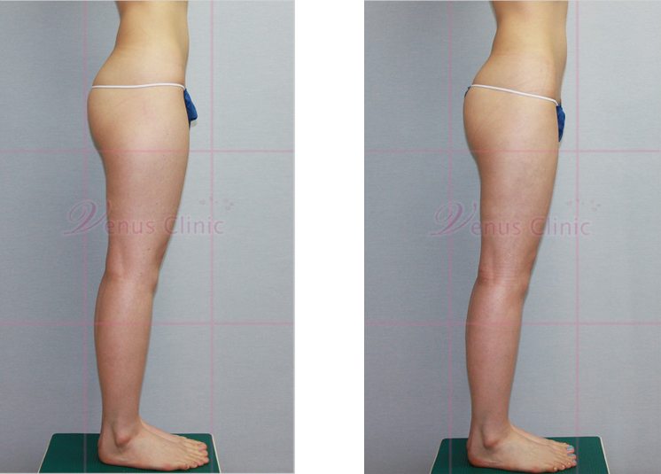 허벅지 지방흡입 전후사진3