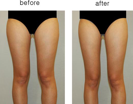 허벅지 정면사진1