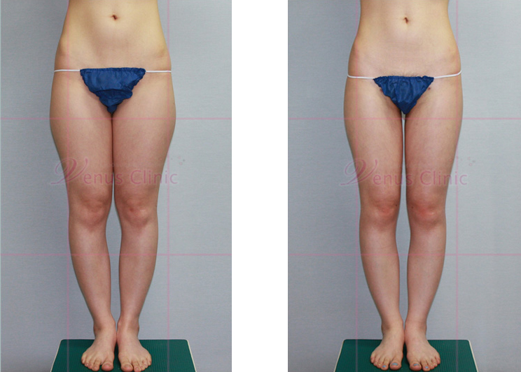 허벅지 지방흡입 전후사진1