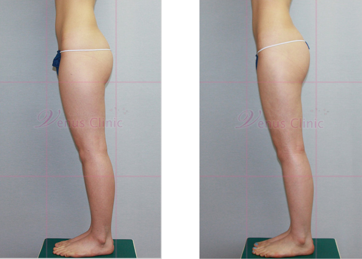 허벅지 지방흡입 전후사진2