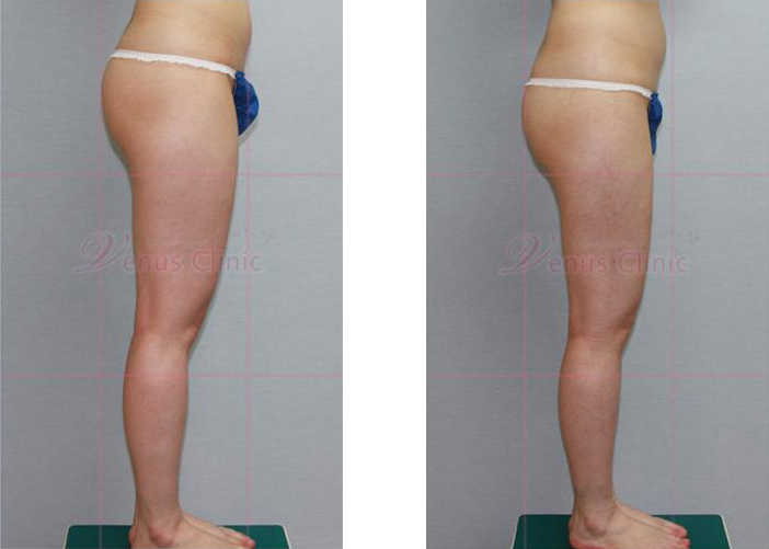 허벅지와 엉덩이 지방흡입 전후사진4