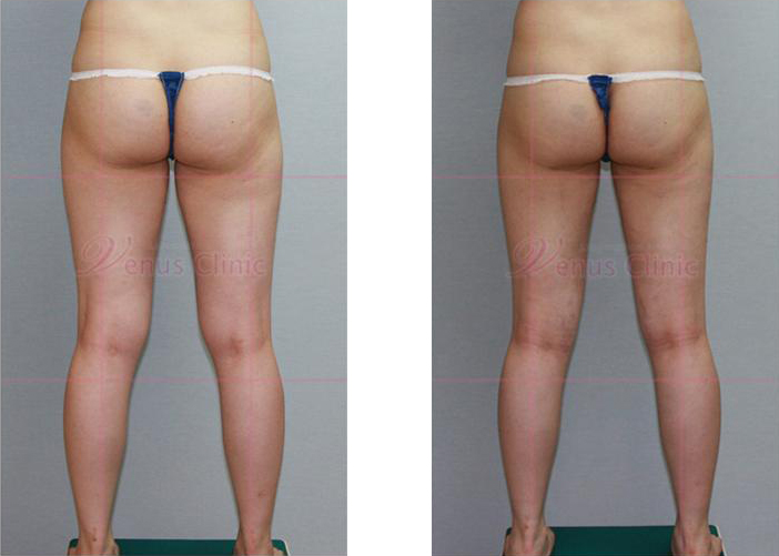 허벅지와 엉덩이 지방흡입 전후사진3