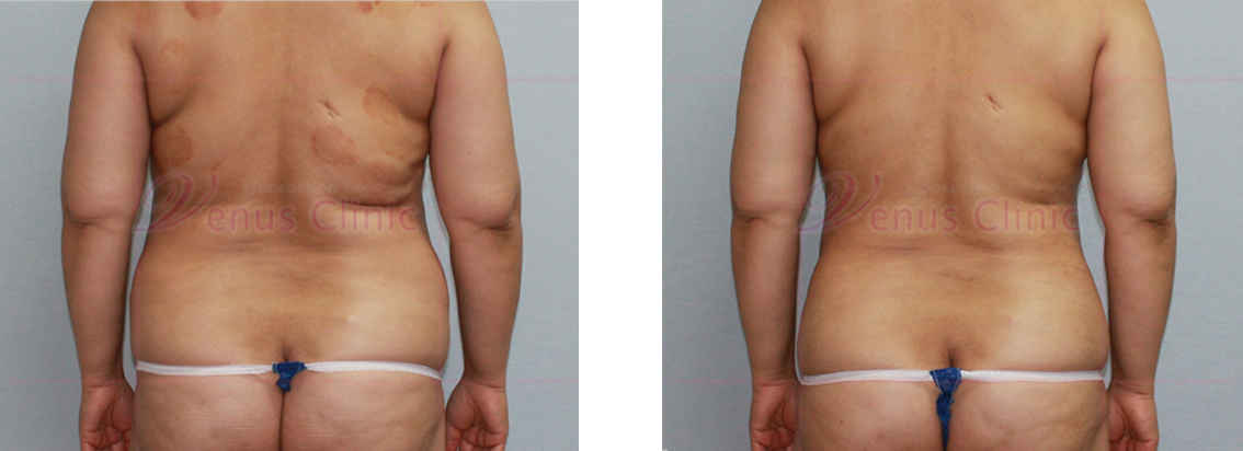 복부 지방흡입 전후사진 후면