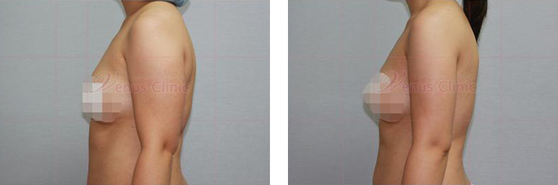 팔지방흡입 전후사진