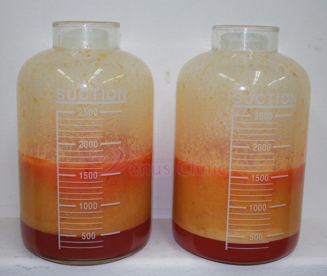 040106_3.jpg 지방흡입후 제거된 지방의 모습