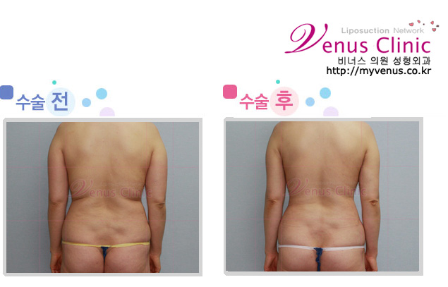 등과 허리 팔의 지방흡입 전후사진1