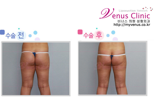 엉덩이와 허벅지 지방흡입 전후사진4