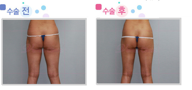 엉덩이와 허벅지 지방흡입 전후사진5