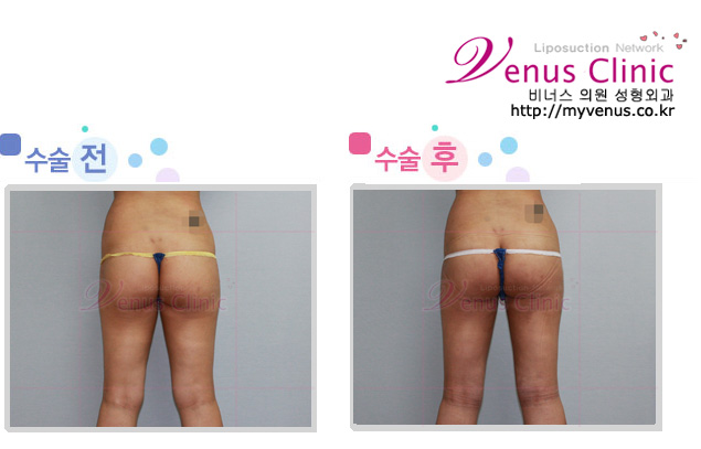 엉덩이와 허벅지 지방흡입 전후사진3