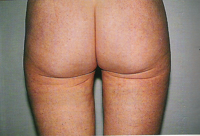 엉덩이 받침대의 이중주름