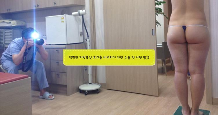 지방흡입 전후사진 촬영