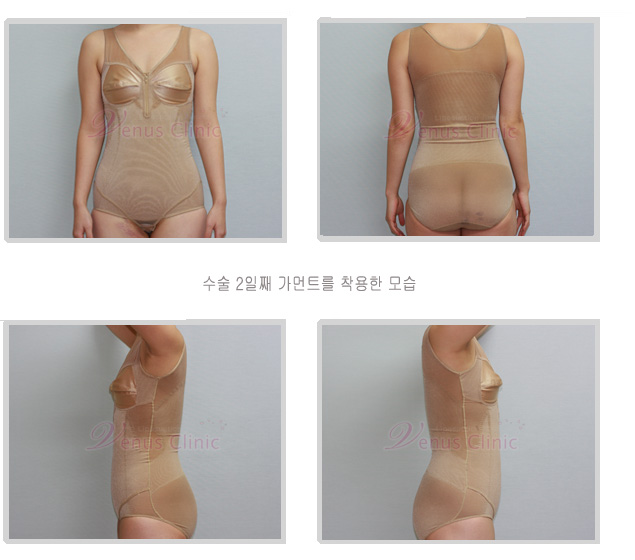 미스 비너스의 복부 지방흡입 수술후2일째 압박복 착용모습