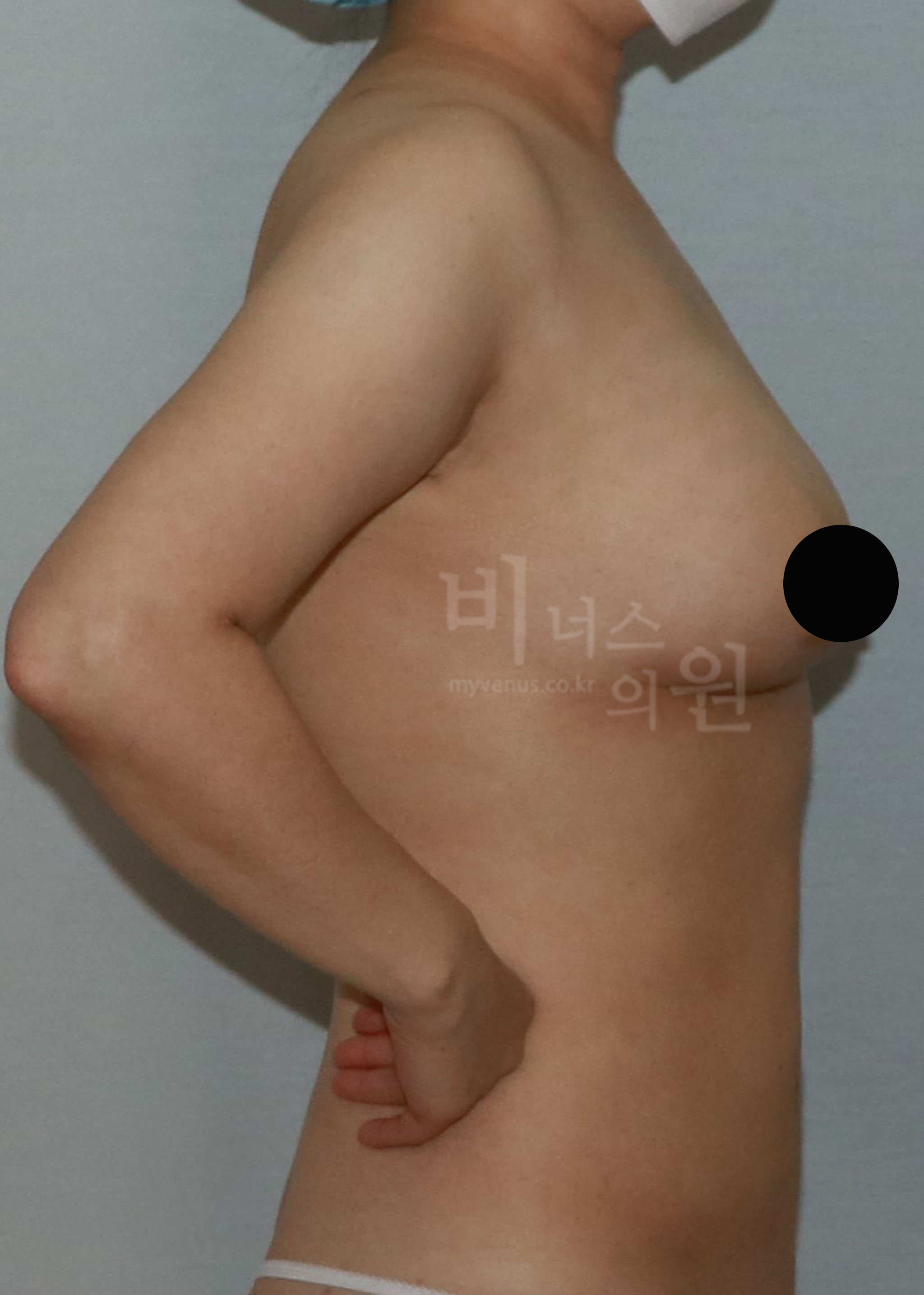 가슴 축소 지방흡입.jpg