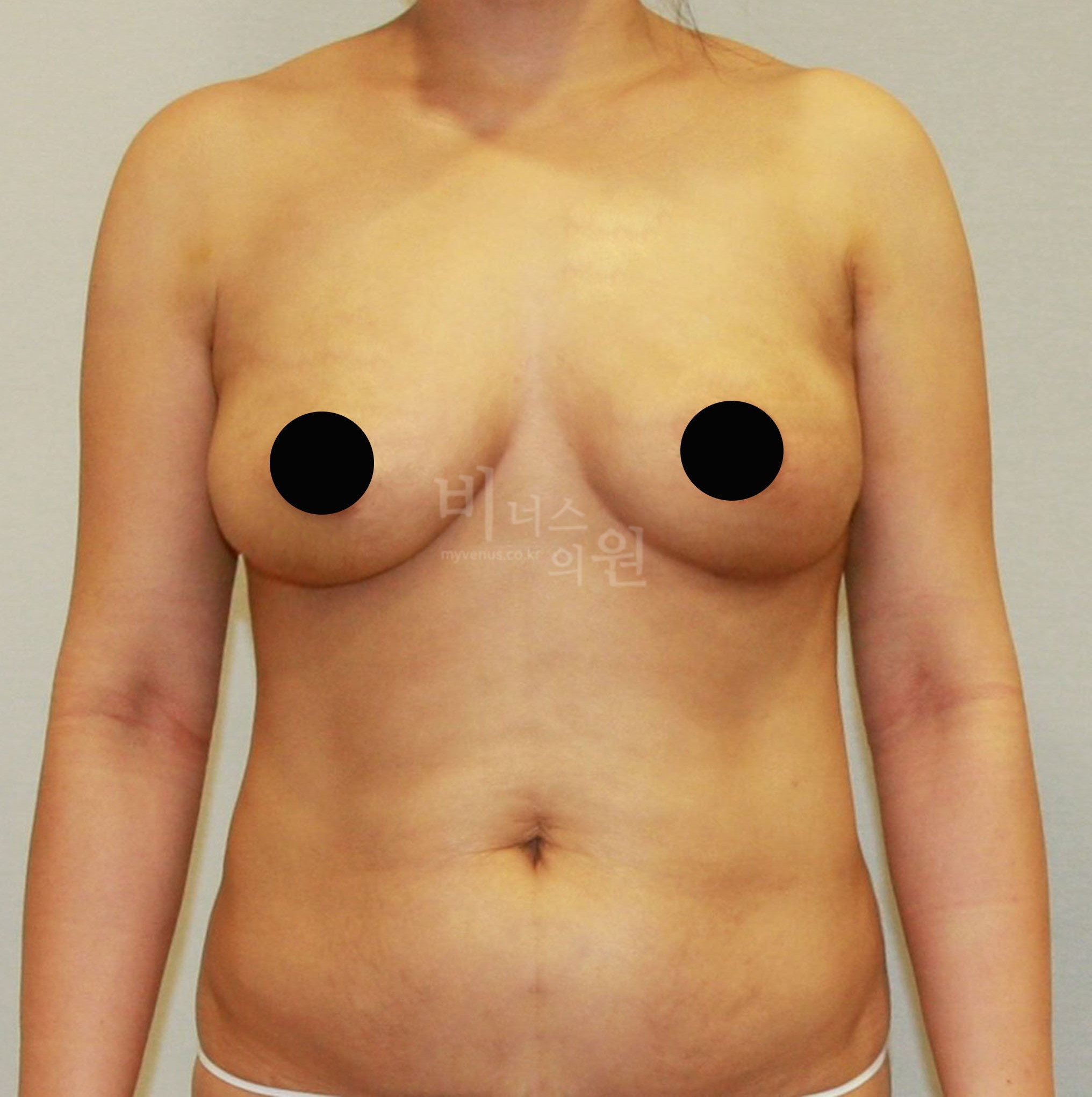 가슴 리프팅.jpg