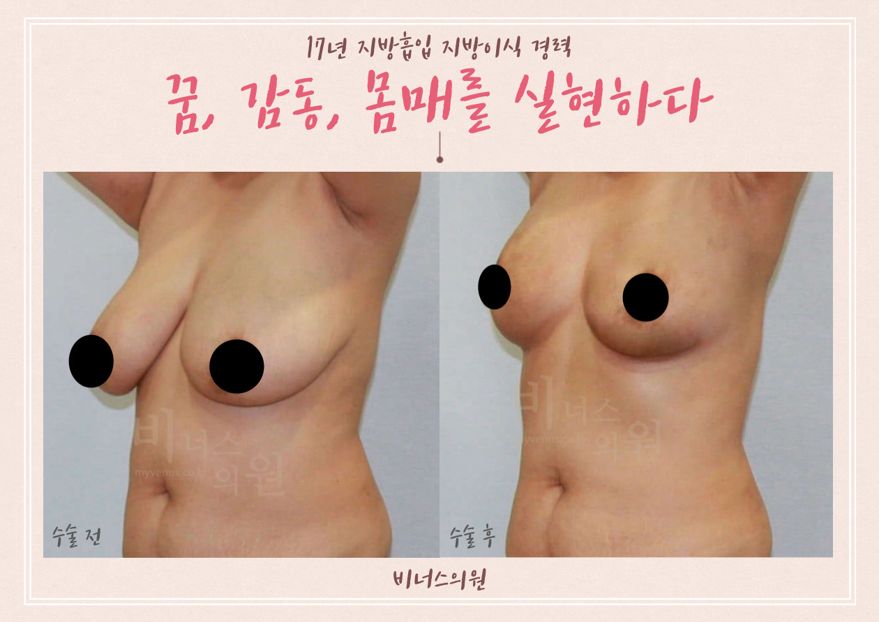 가슴축소_지방흡입