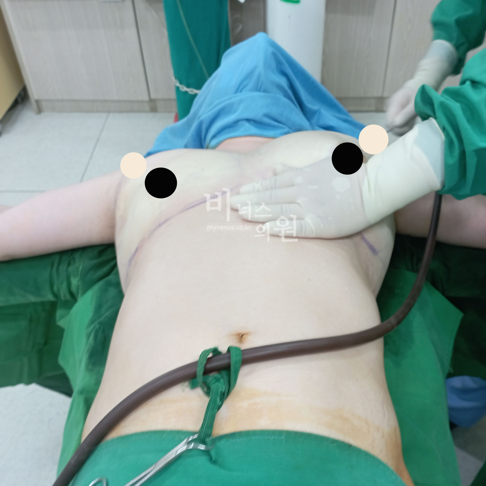 핸드메이드 지방흡입.jpg