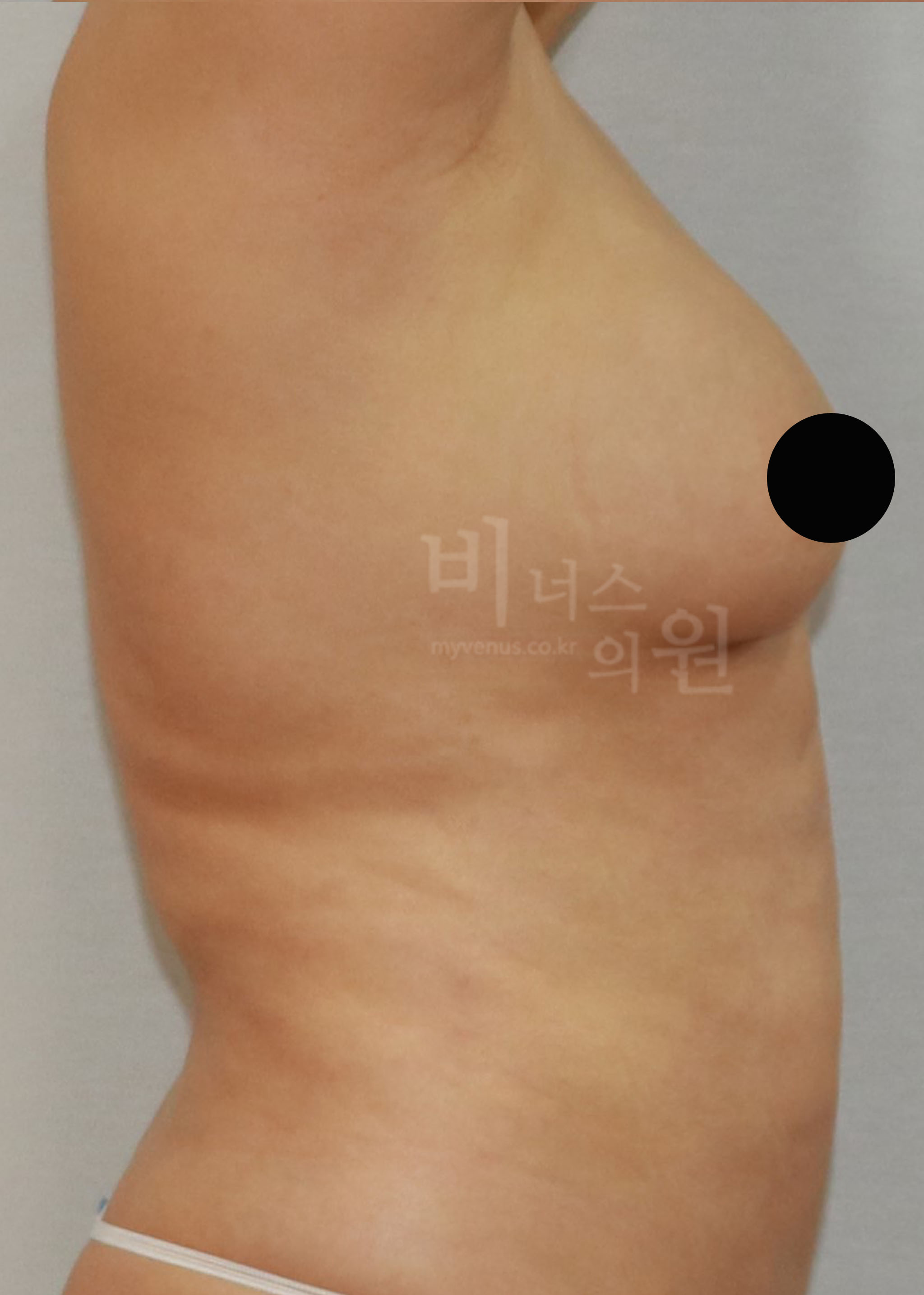 유방 축소 지방흡입.jpg