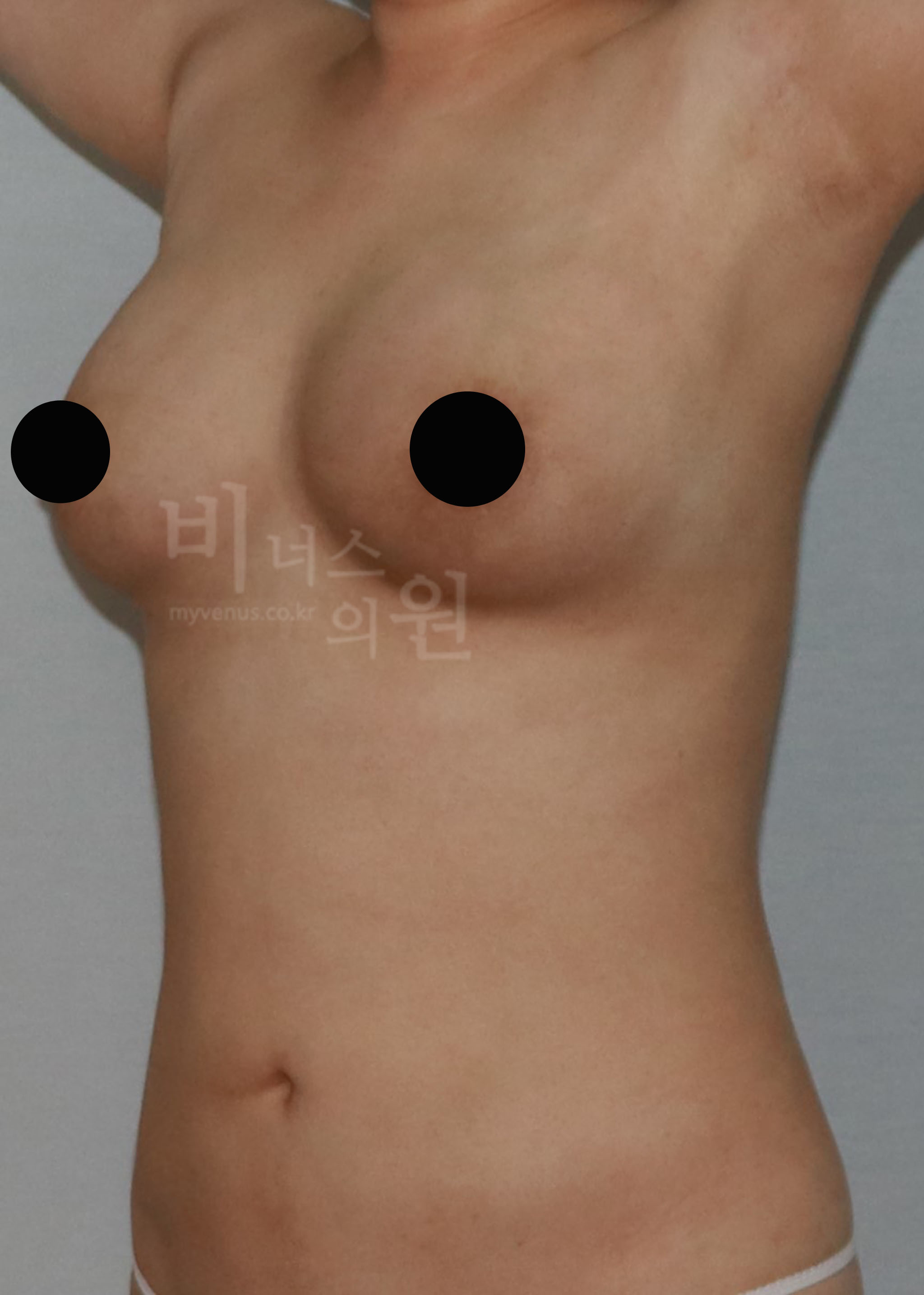 가슴 지방흡입.jpg