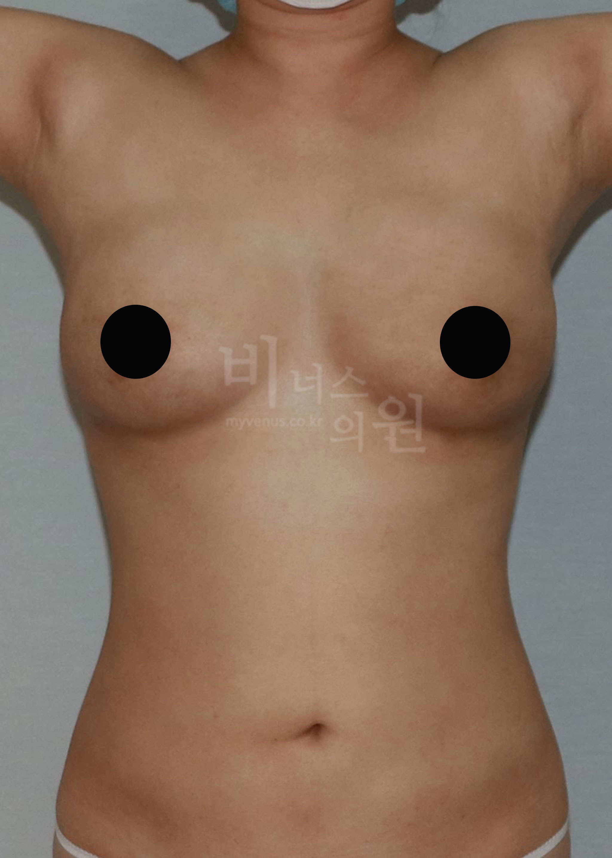 지방흡입 가슴축소술.jpg