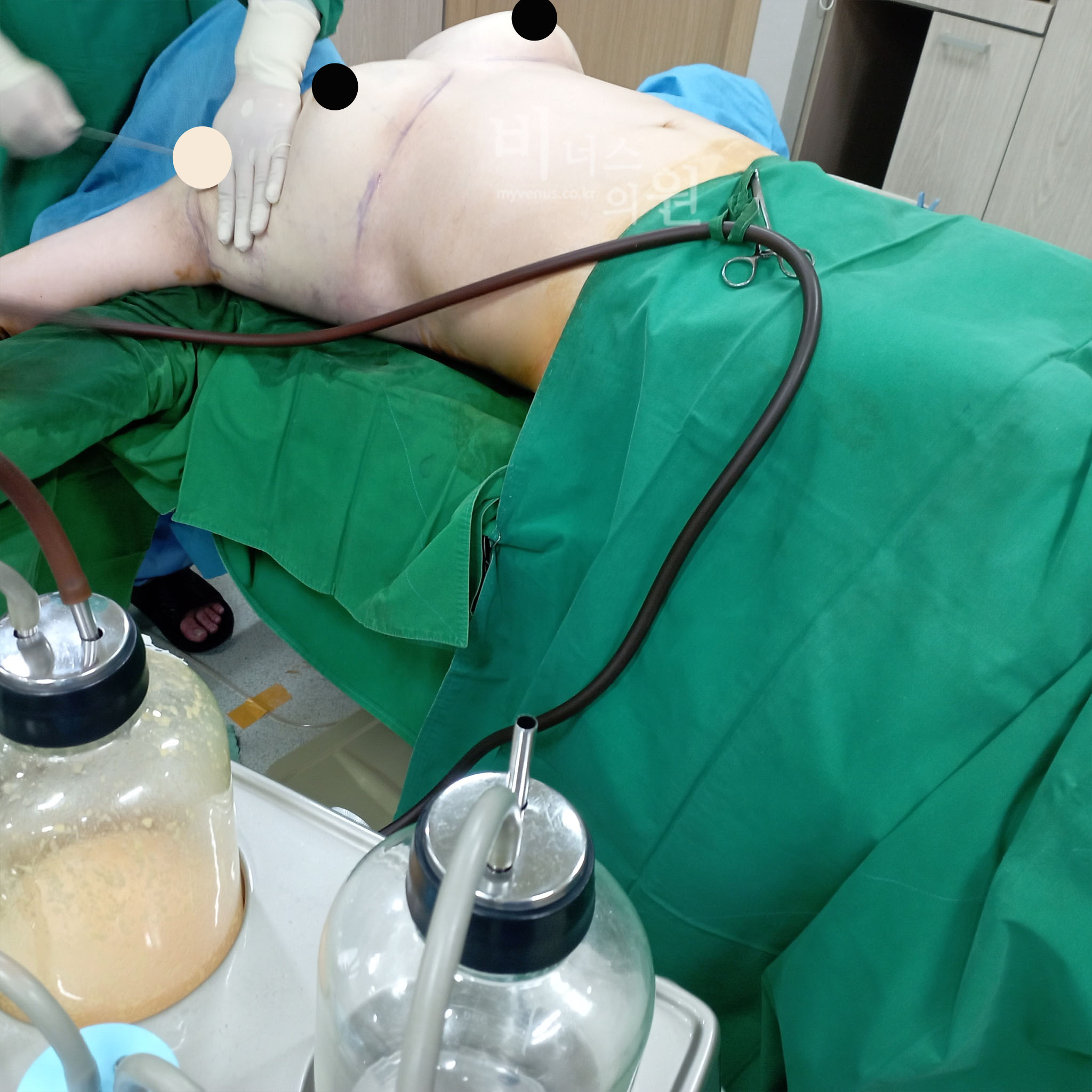 가슴 지방 흡입.jpg