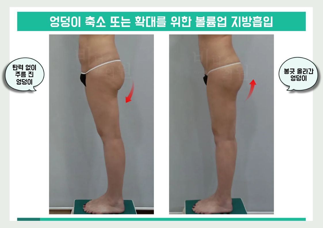부천엉덩이지방흡입.jpg