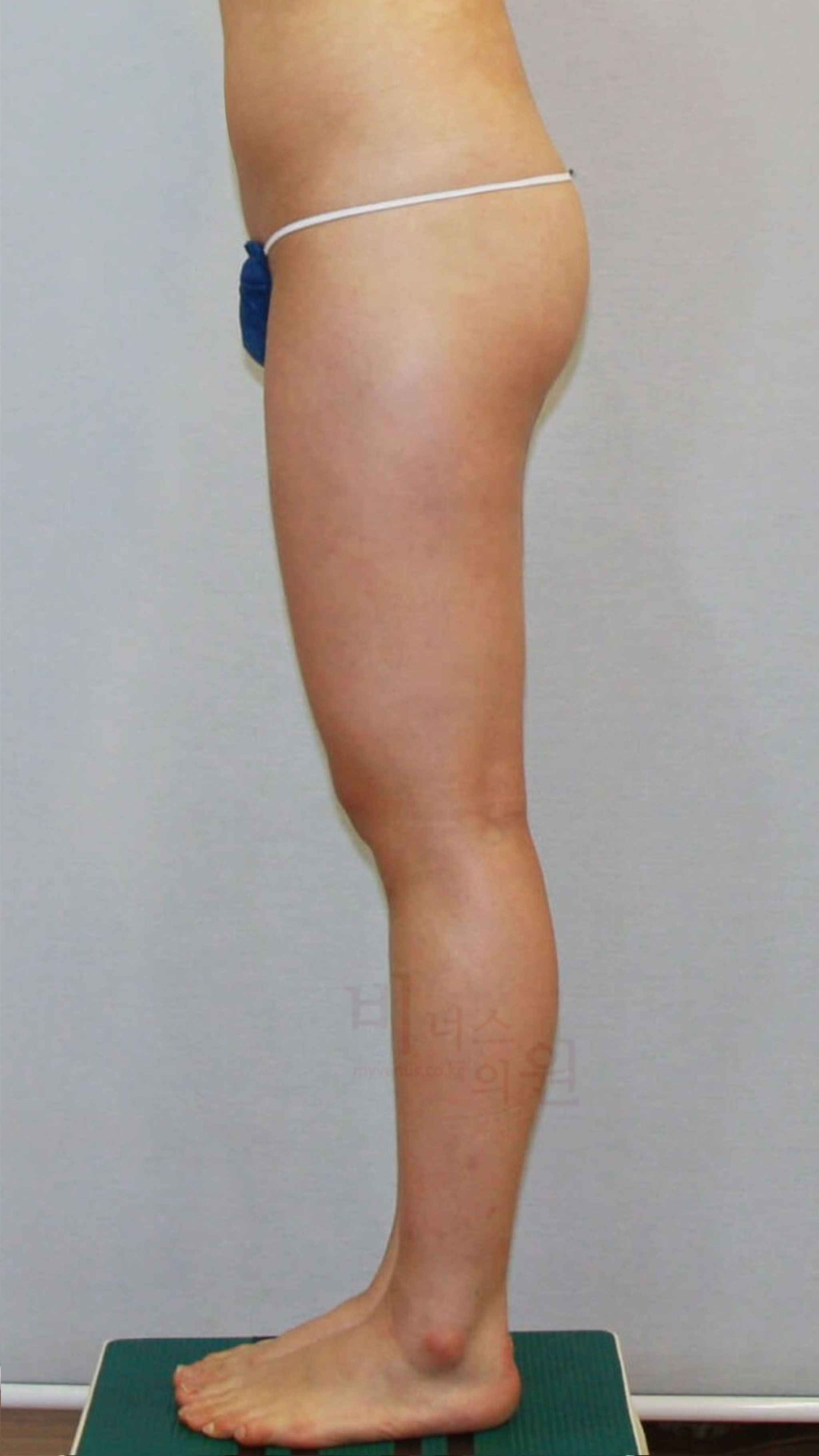 엉덩이 지방흡입.jpg