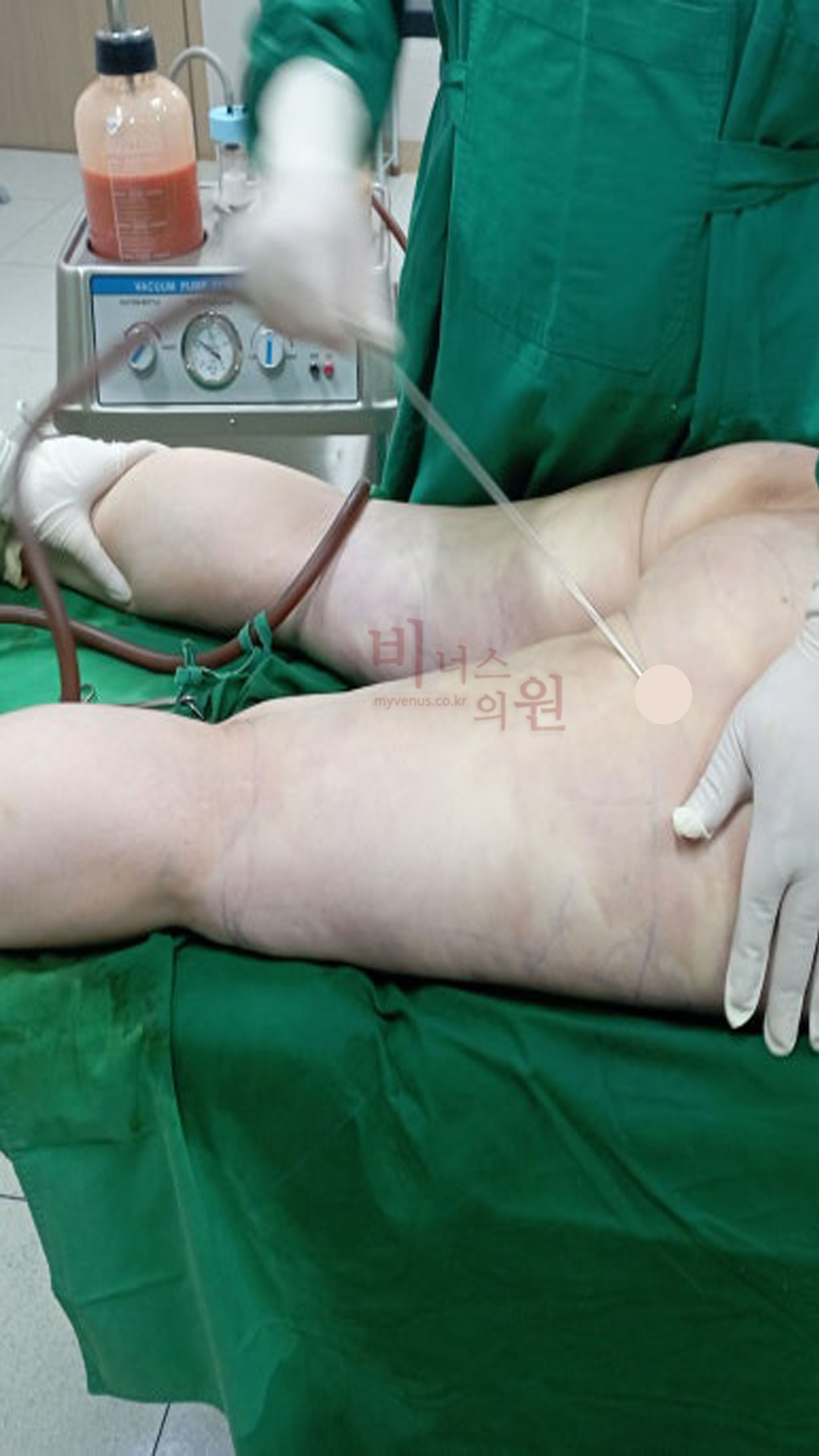 무릎 지방흡입.jpg
