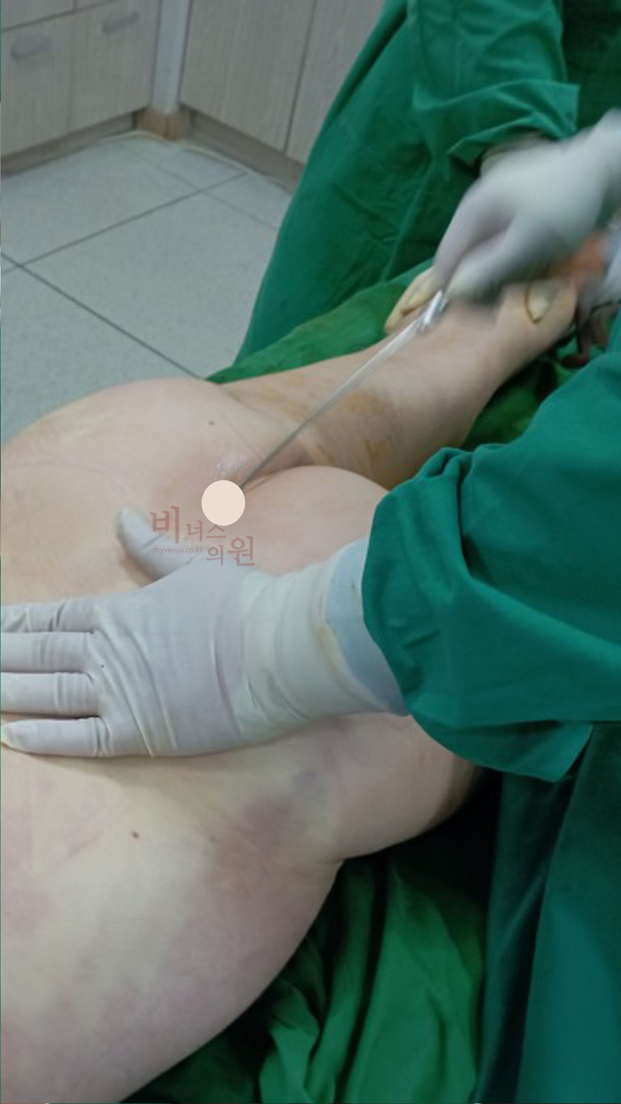 허벅지 지방흡입.jpg
