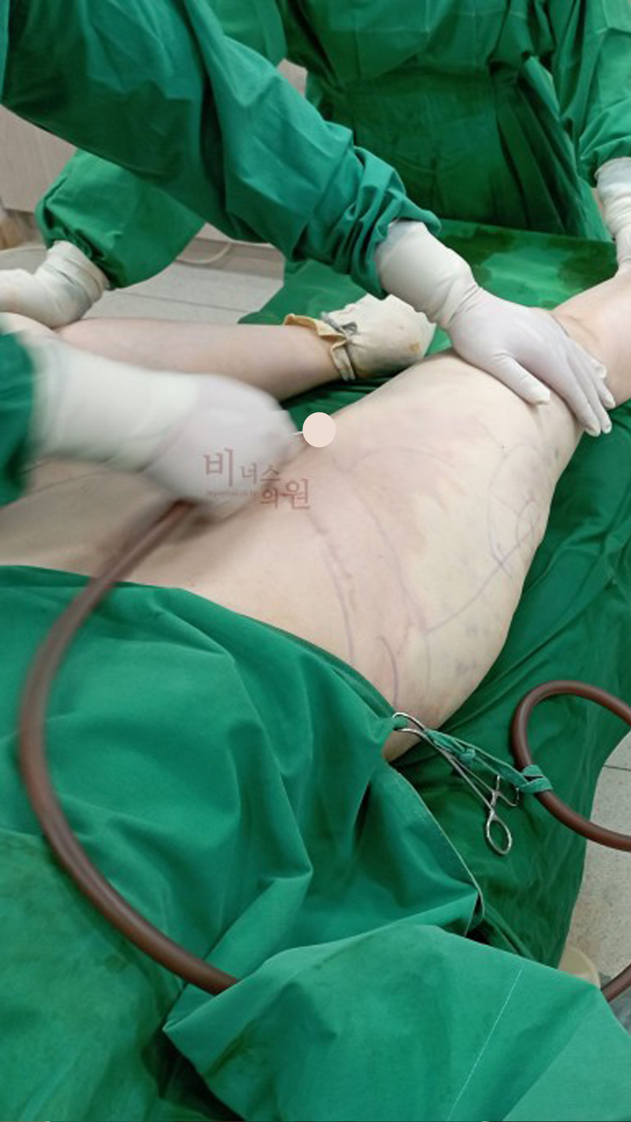 허벅지 승마살 지방흡입.jpg