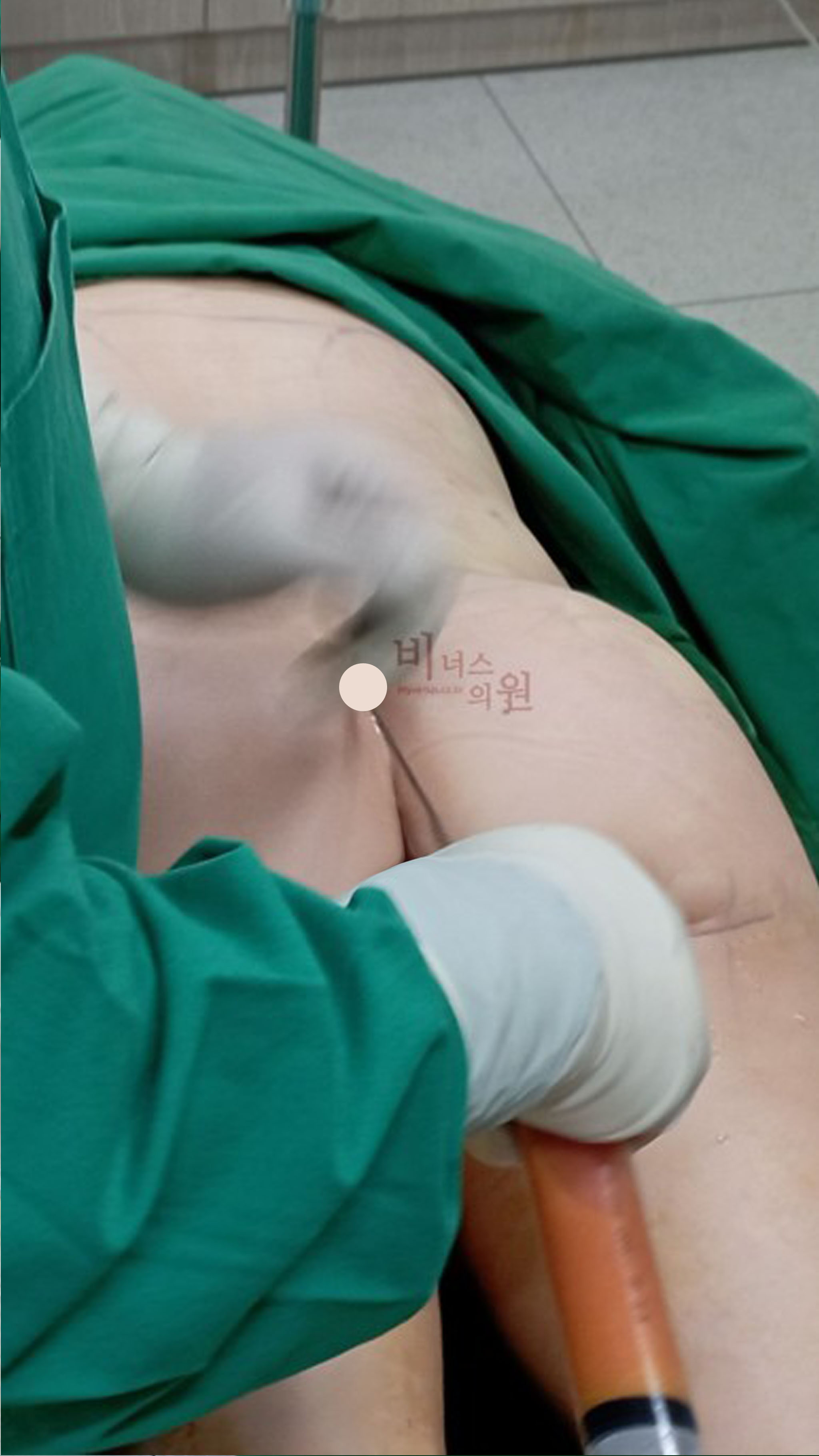 허벅지 엉덩이 지방흡입.jpg