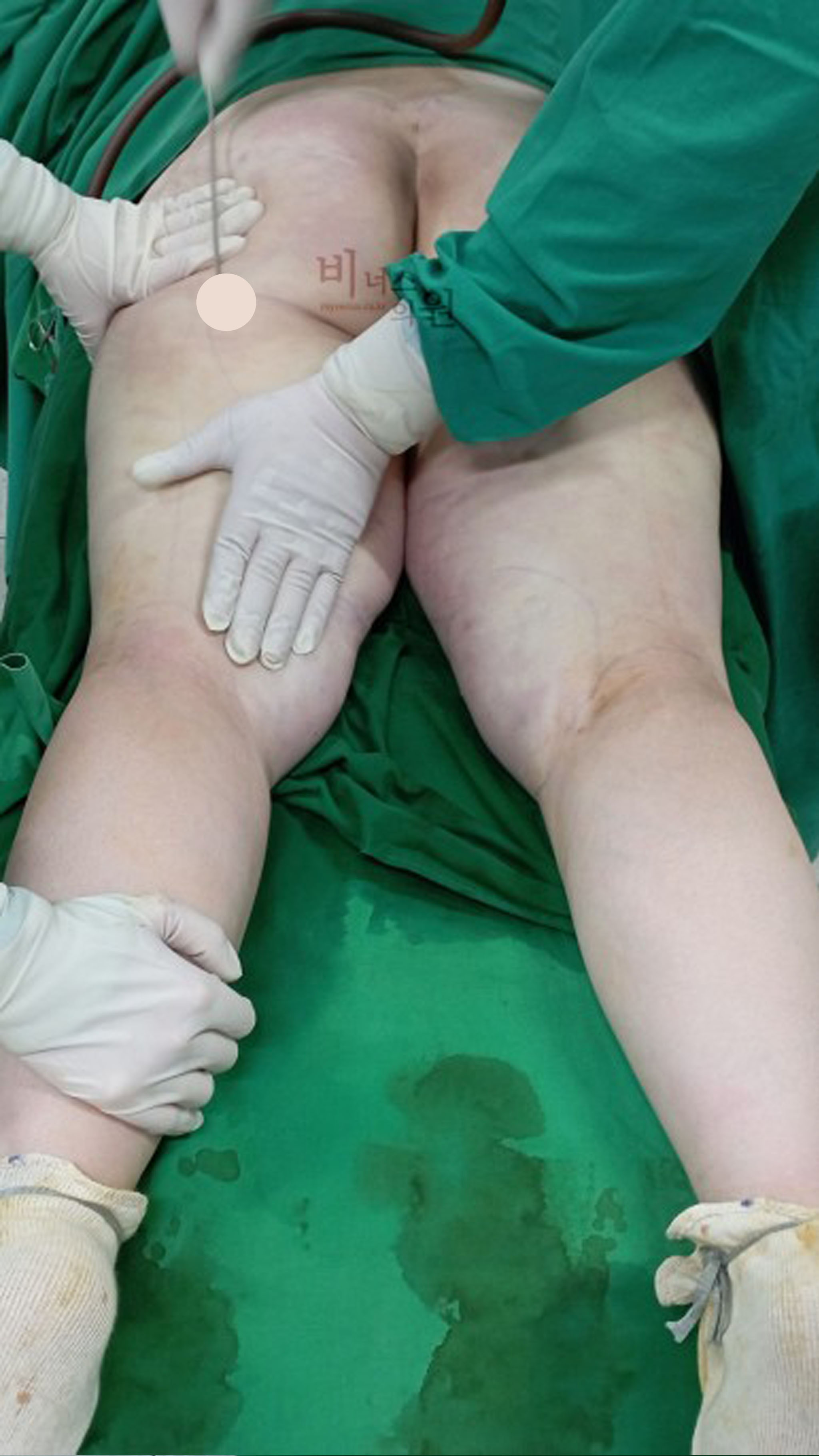 허벅지 미니 지방흡입.jpg