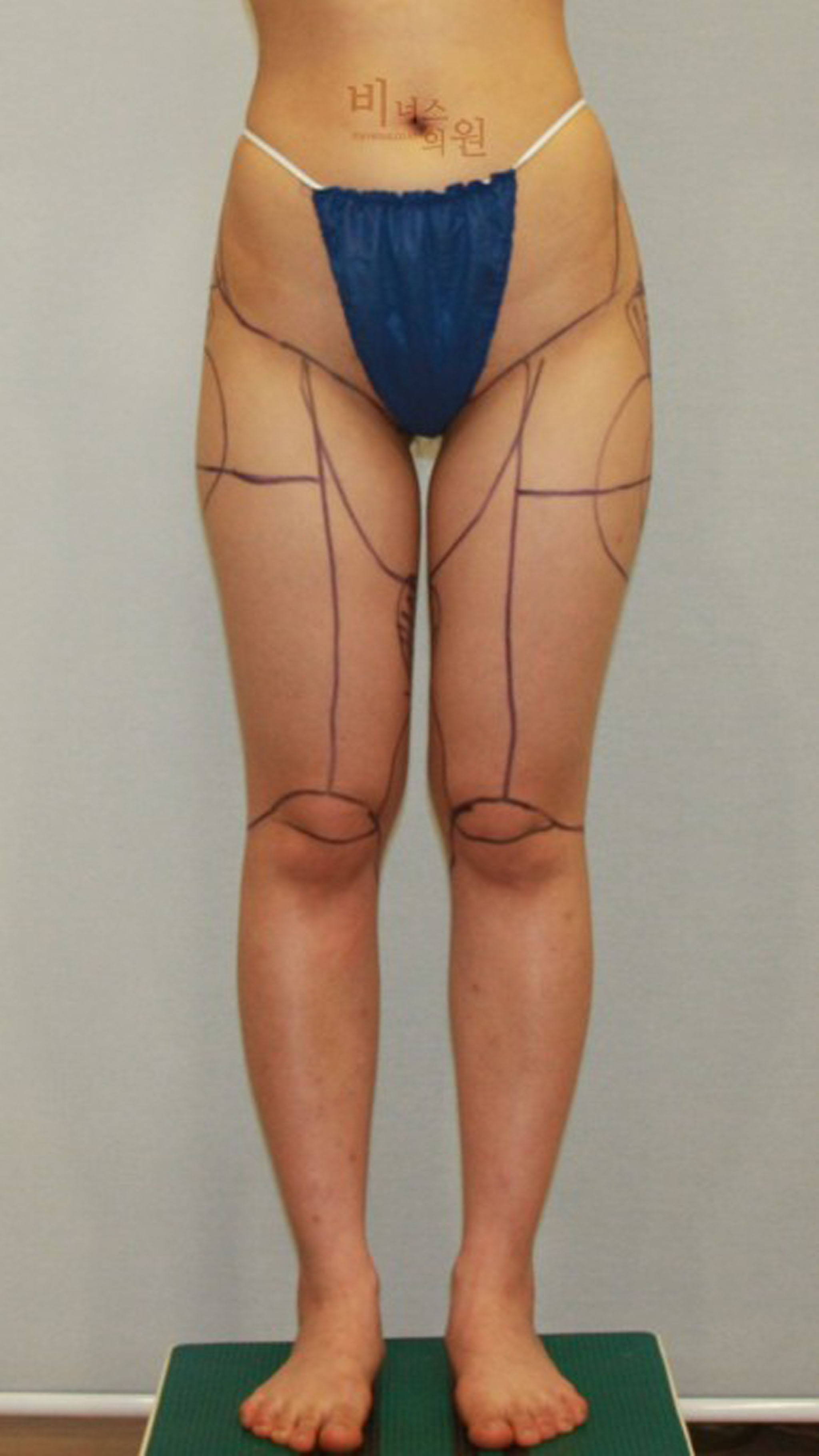 허벅지지방흡입.jpg
