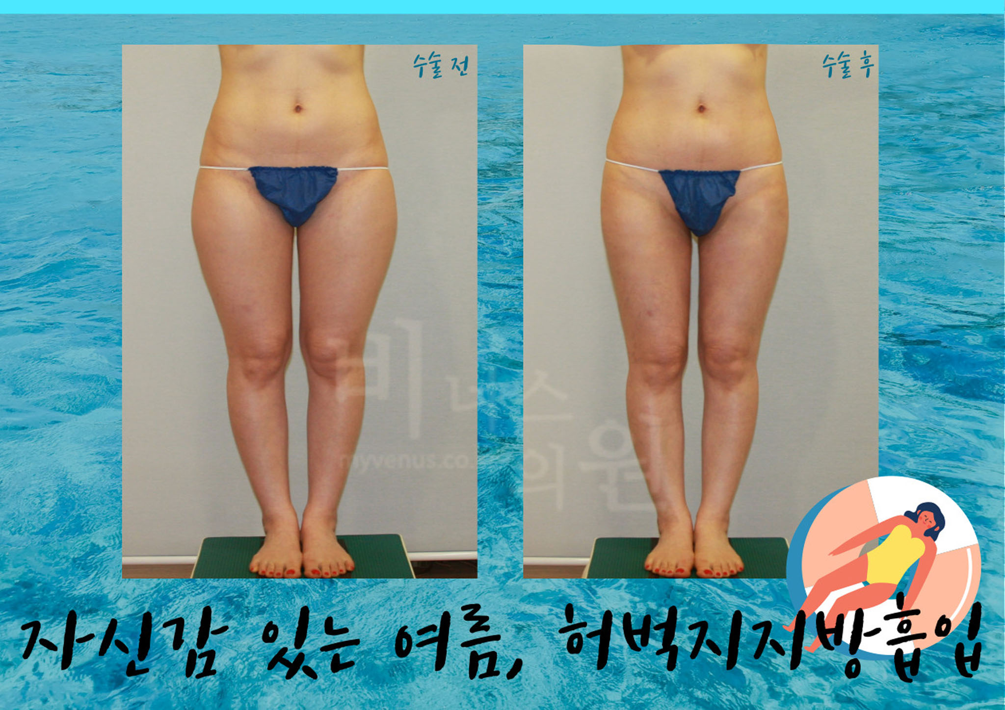 허벅지 지방흡입