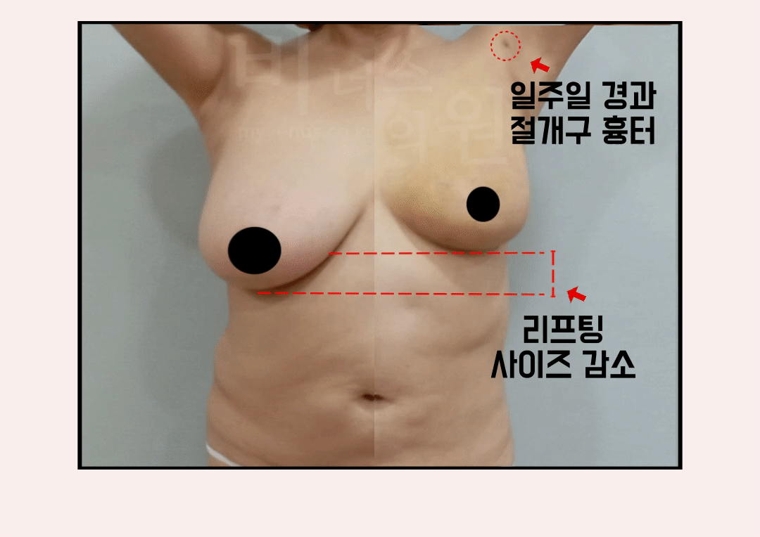 유방축소 지방흡입.gif