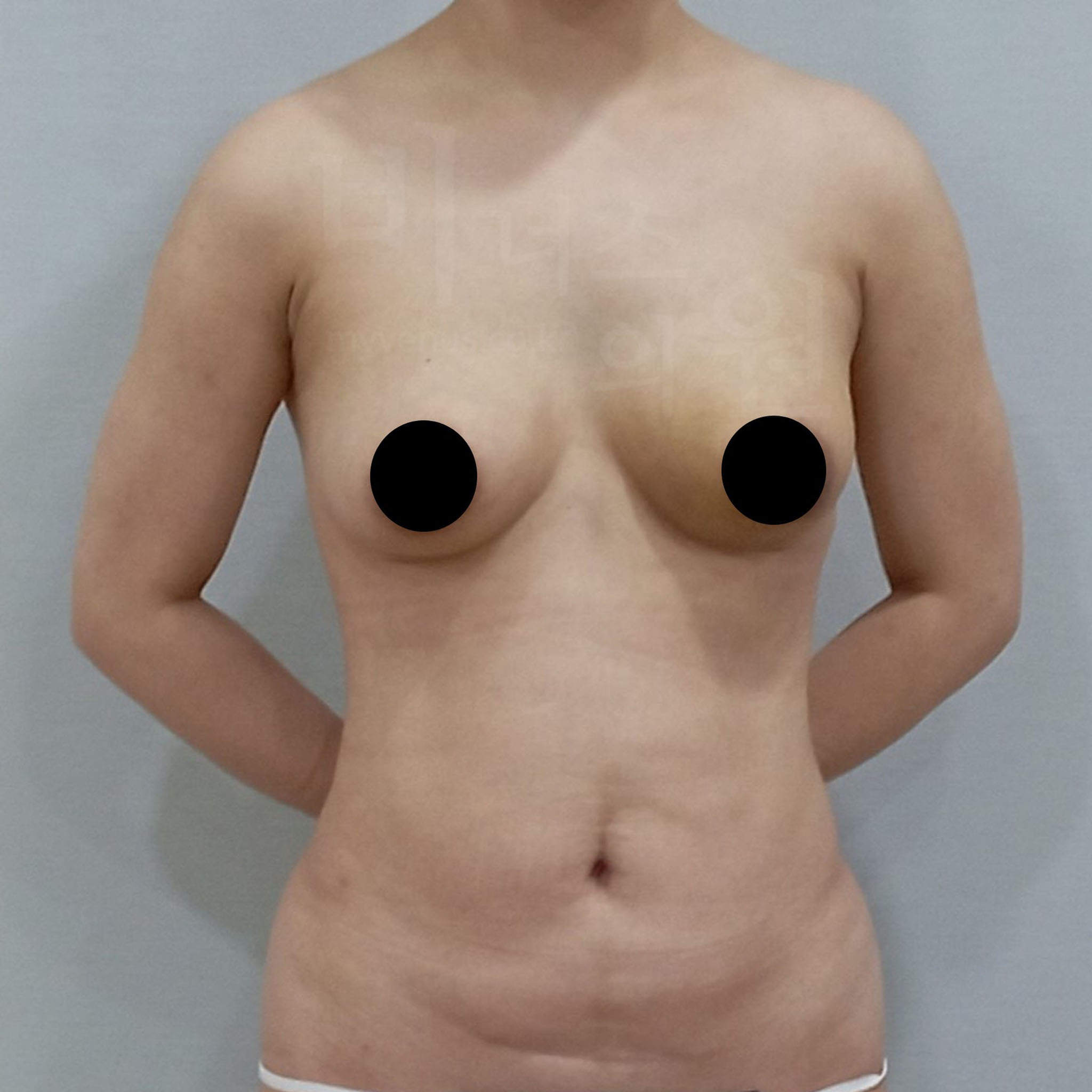 유방축소 절개.jpg