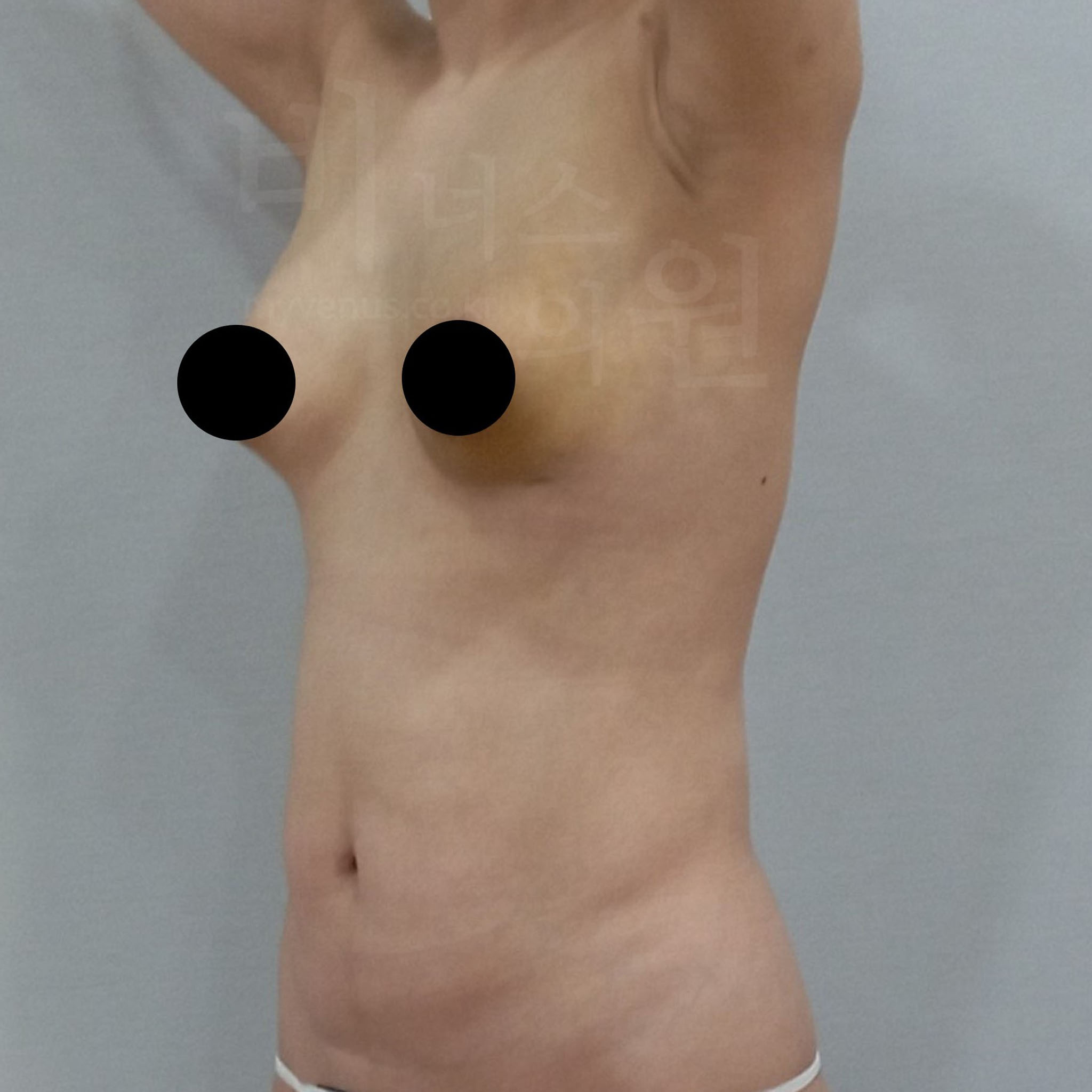 지방흡입 회복.jpg