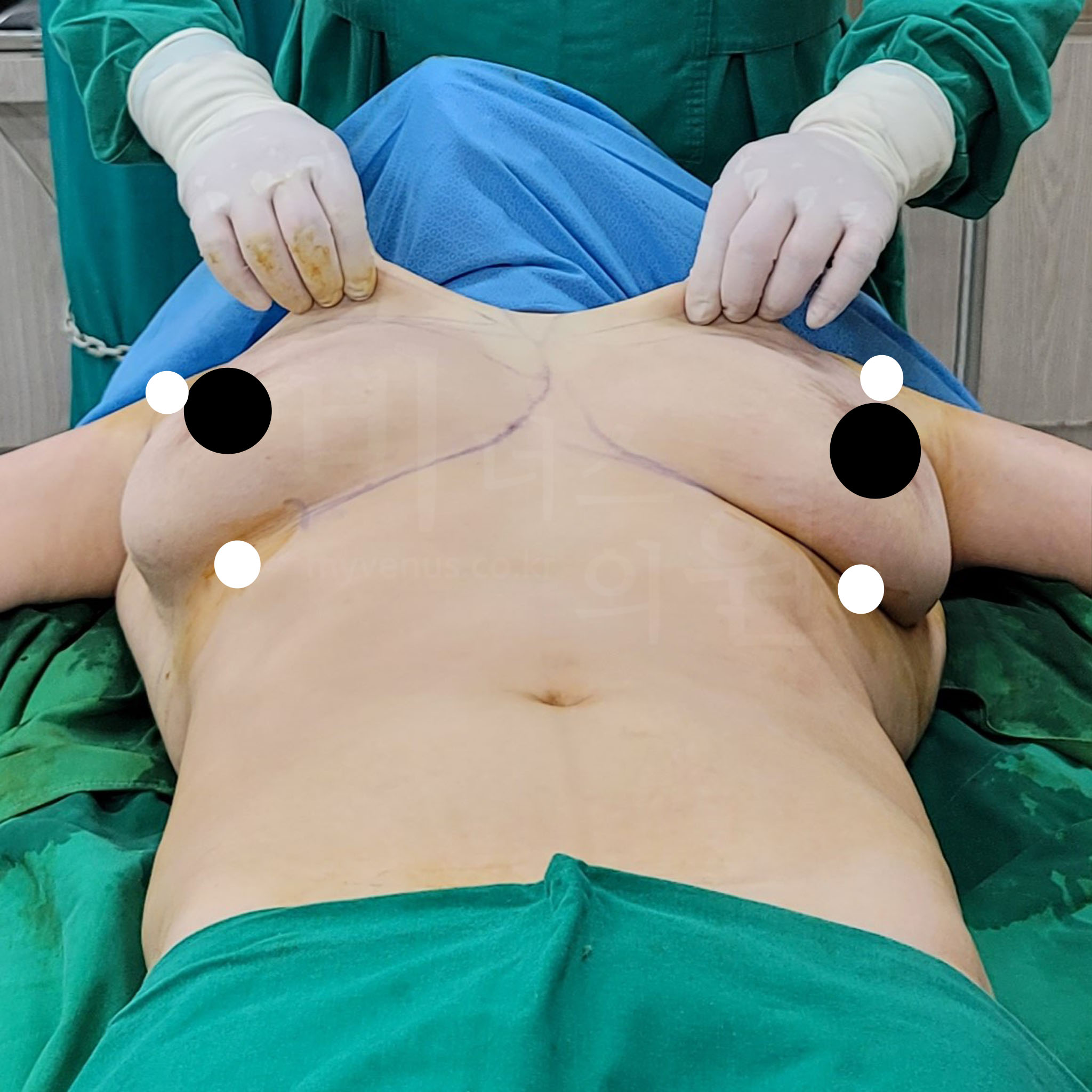 지방흡입 멍.jpg