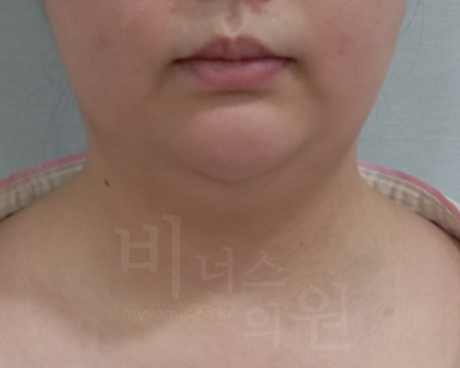 턱밑살지방흡입.jpg