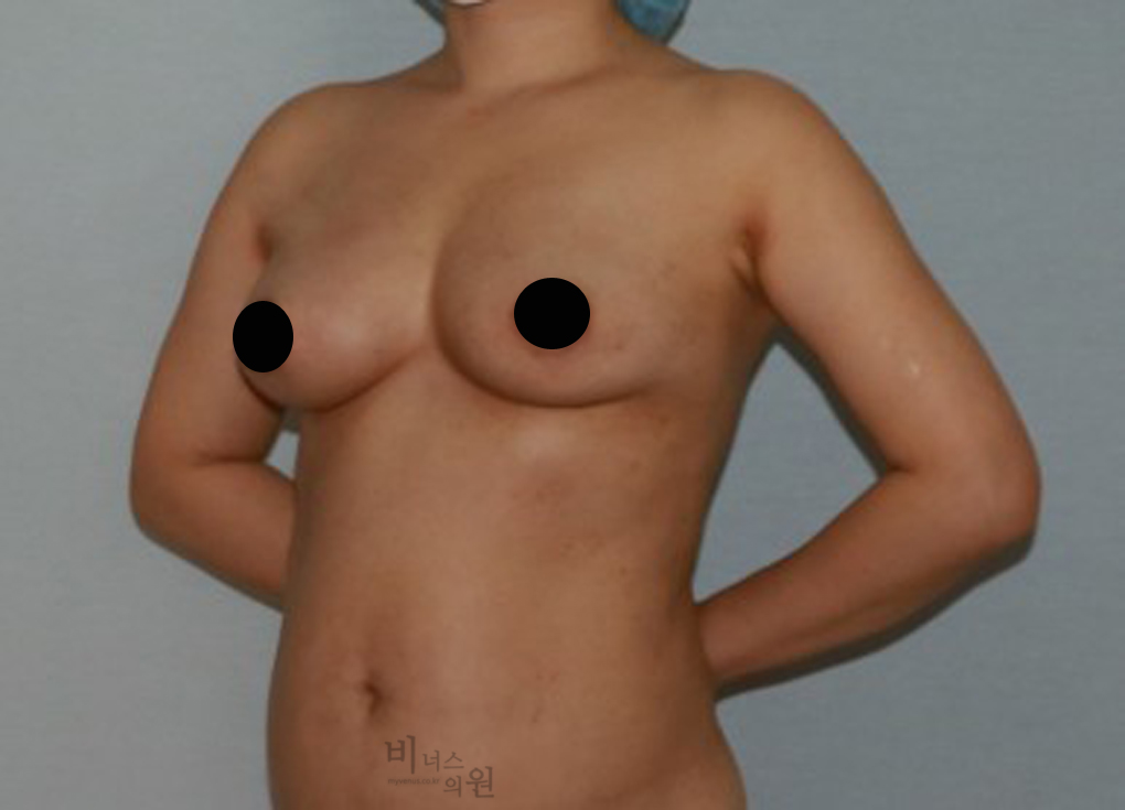 가슴축소지방흡입6.jpg