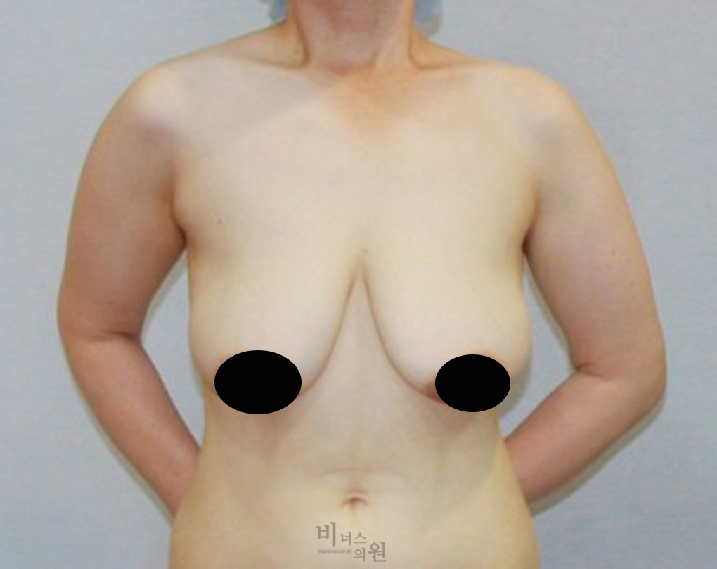 가슴축소지방흡입13.jpg