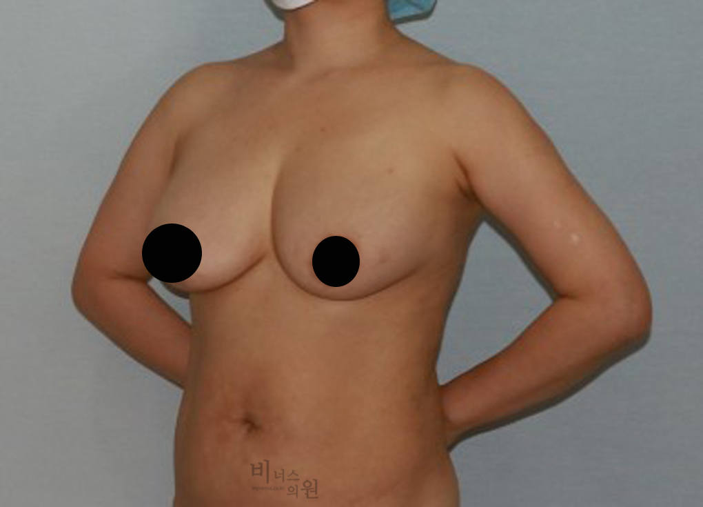 가슴축소지방흡입5.jpg