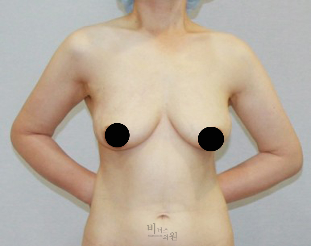 가슴축소지방흡입14.jpg