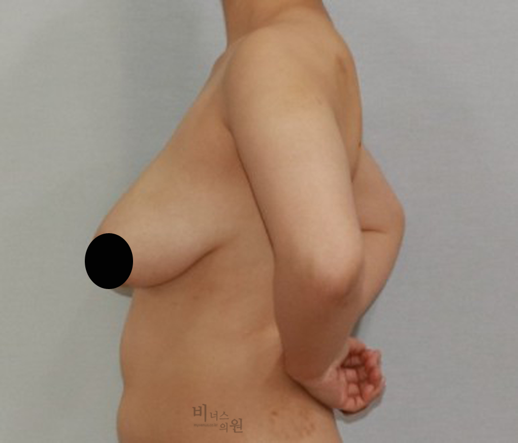 가슴축소지방흡입9.jpg