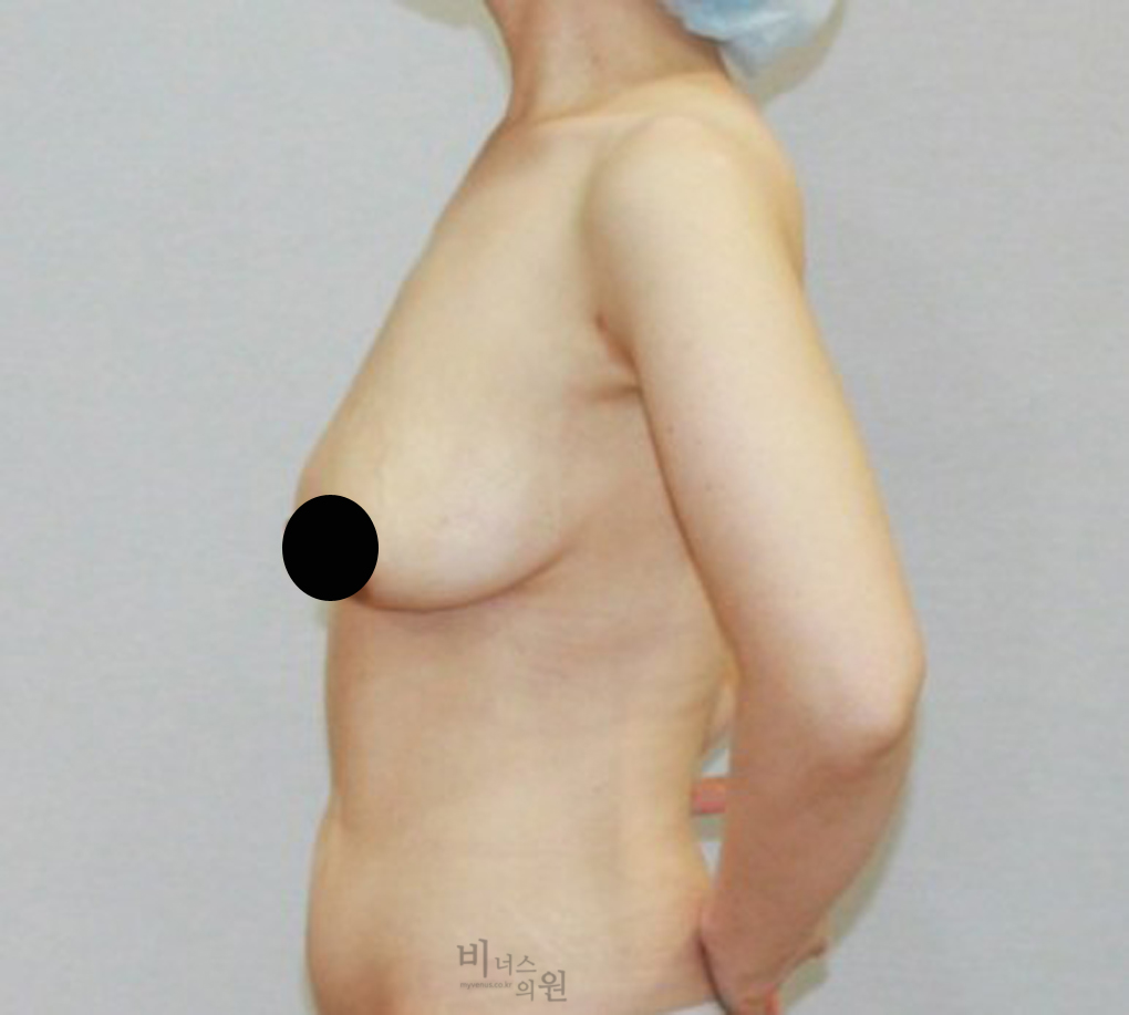 가슴축소지방흡입16.jpg