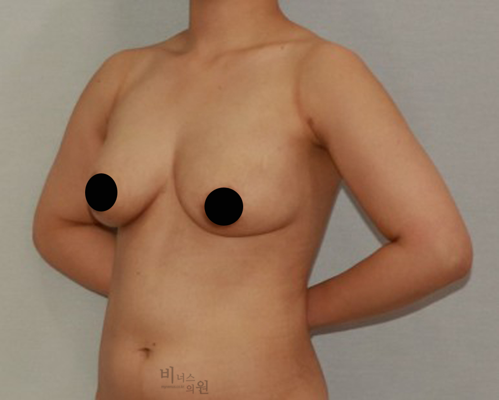 가슴축소지방흡입12.jpg