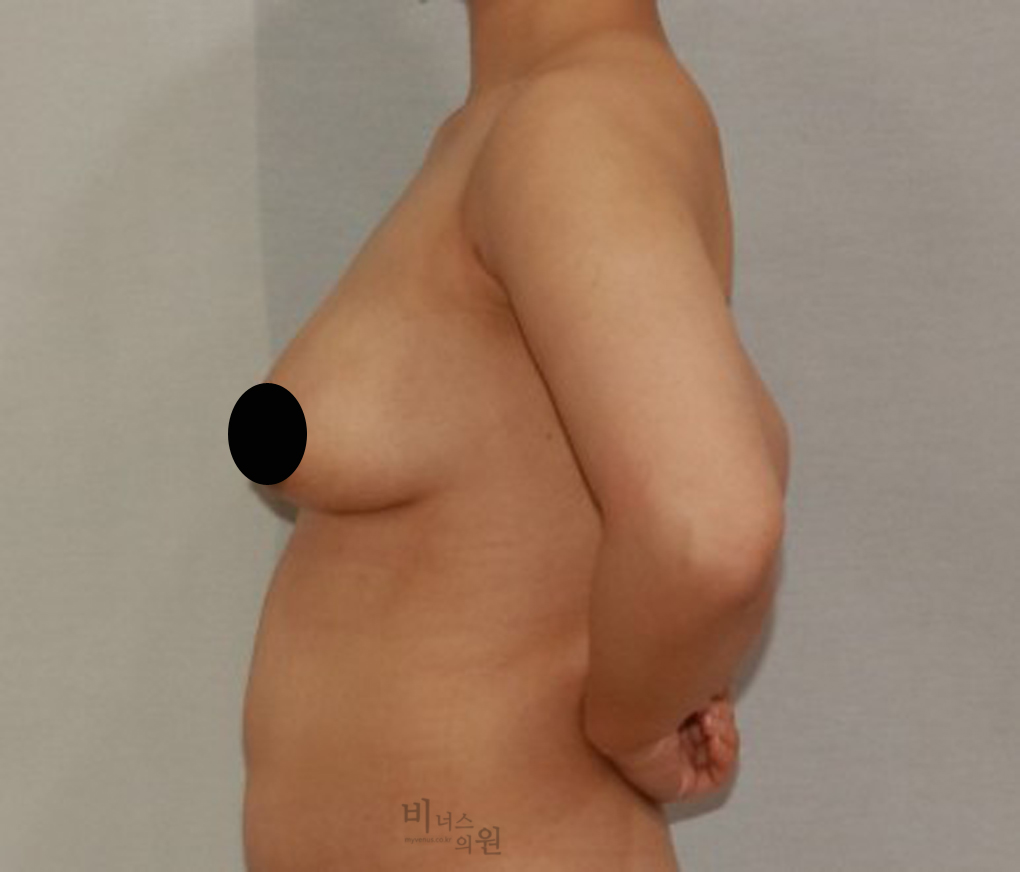 가슴축소지방흡입10.jpg