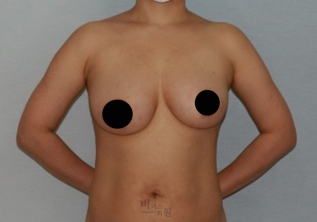가슴축소지방흡입1.jpg
