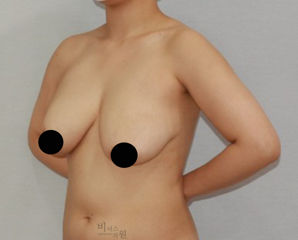 가슴축소지방흡입11.jpg