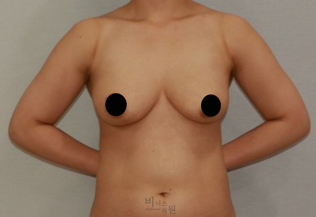 가슴축소지방흡입8.jpg