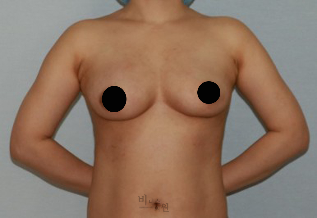 가슴축소지방흡입2.jpg
